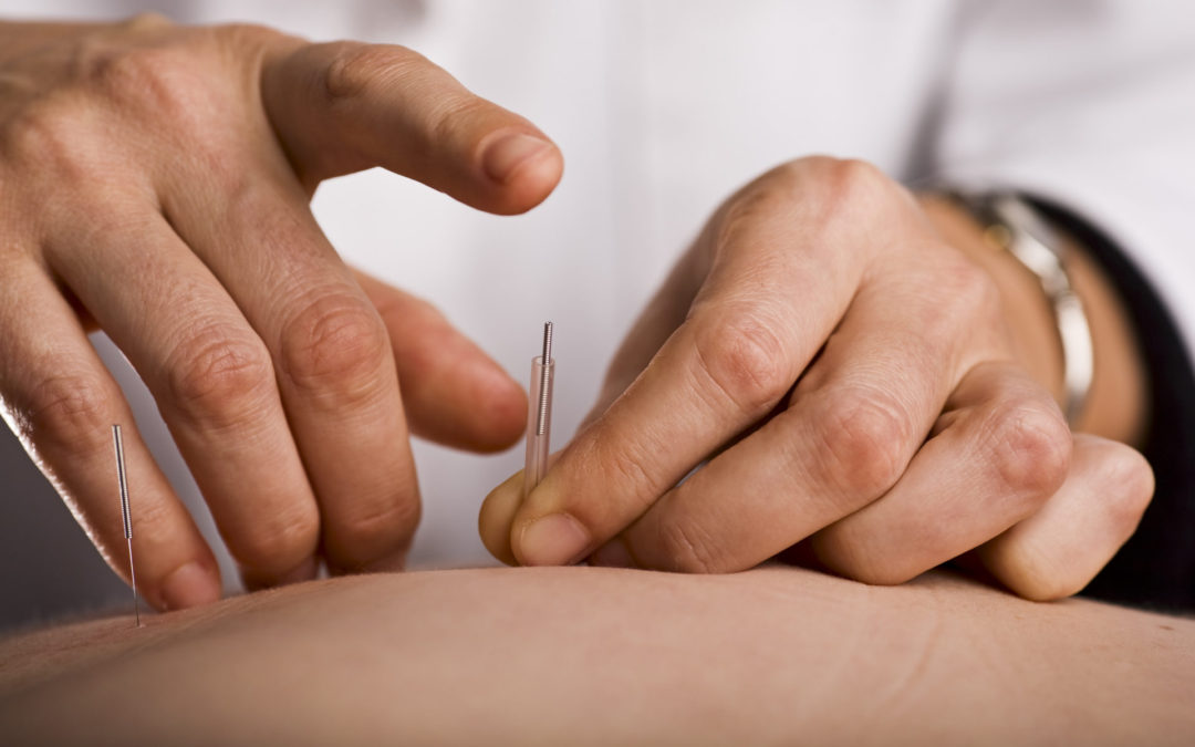 Acupuncture and Dry Needling – What’s the difference?